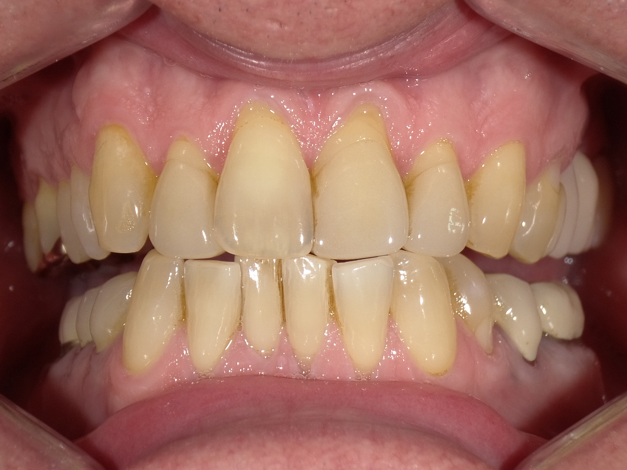 Verfärbte Zähne und freiliegende Zahnhälse